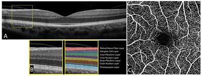OCT and OCT Angiography Offer New Insights and Opportunities in Schizophrenia Research and Treatment